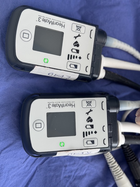 УМБАЛ “Св. Екатерина”: “За втори път в България: В гърдите на още един българин бият две изкуствени сърца“