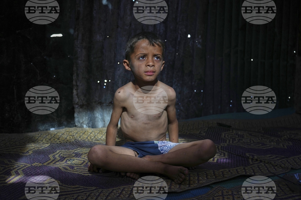 Mideast Wars Malnourished Children