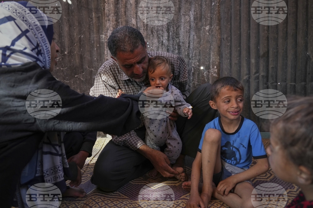 Mideast Wars Malnourished Children