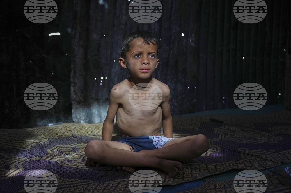 Mideast Wars Malnourished Children