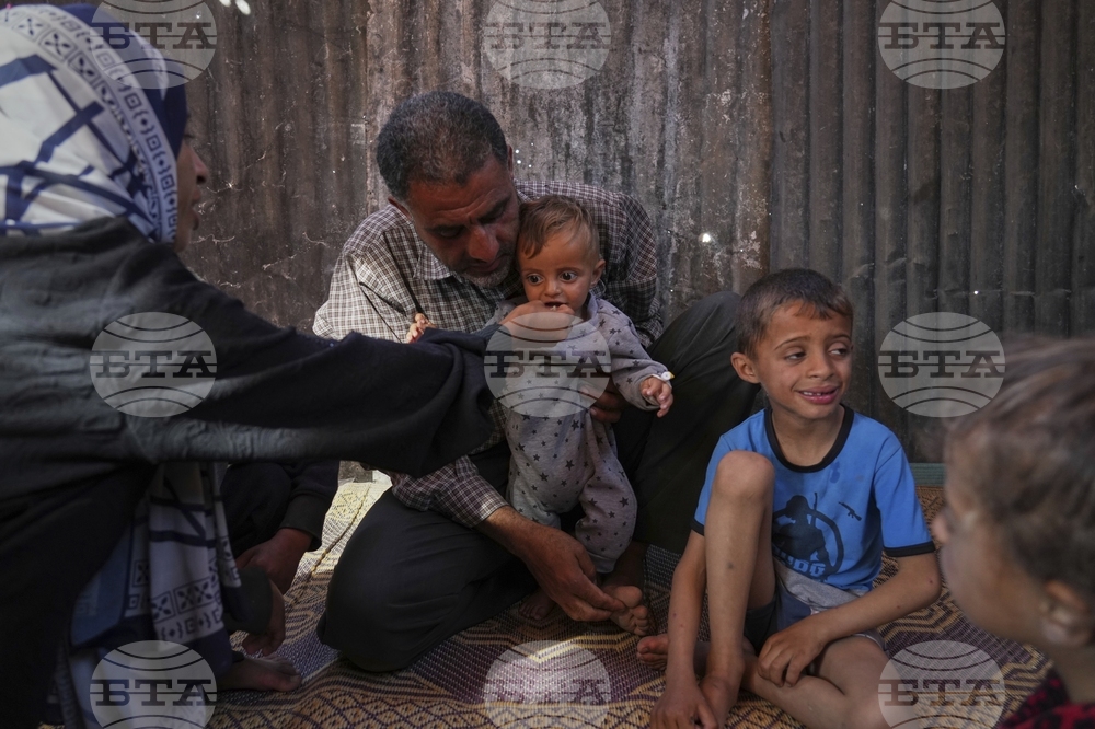 Mideast Wars Malnourished Children