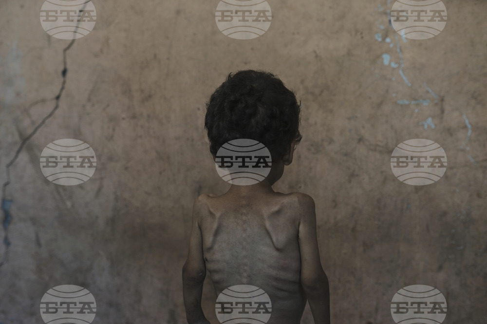 APTOPIX Mideast Wars Dying of Hunger