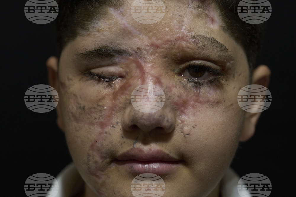 Lebanon Pager Attack Survivors Photo Essay