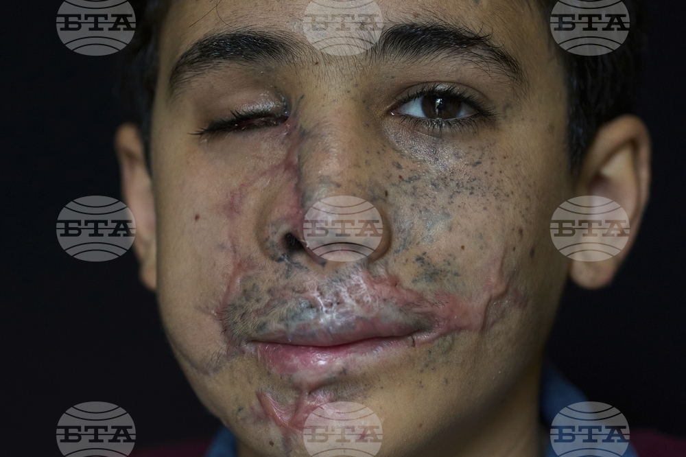 Lebanon Pager Attack Survivors Photo Essay