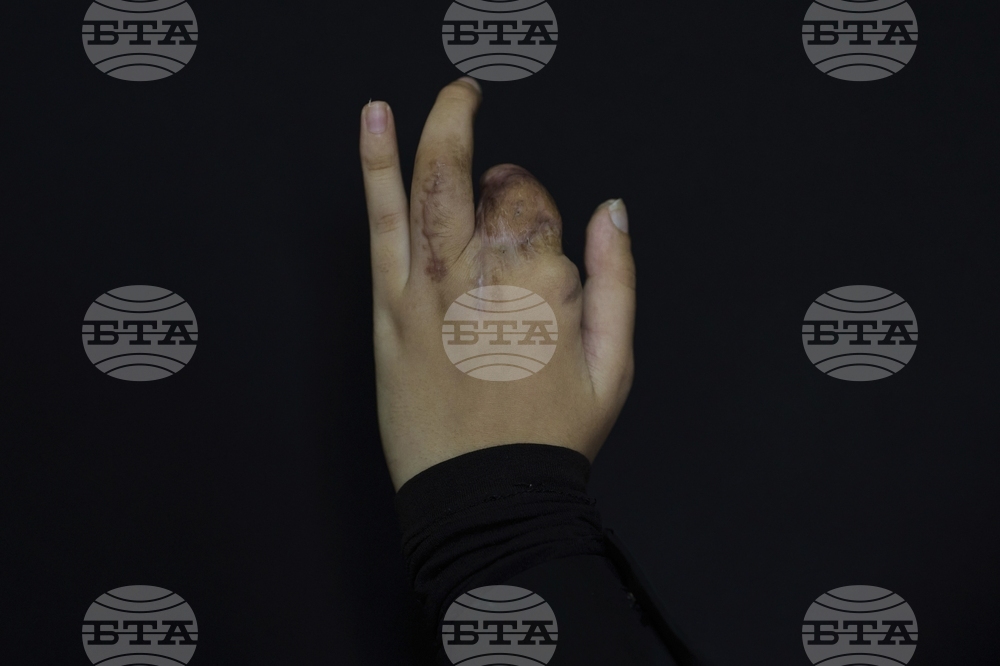 Lebanon Pager Attack Survivors Photo Essay