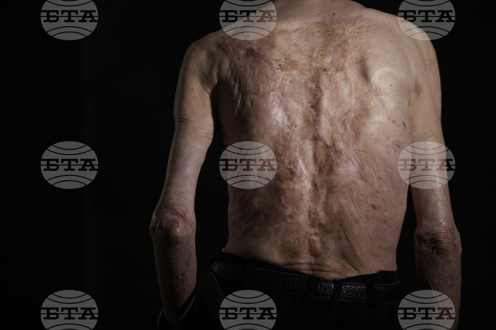 Japan Nagasaki Anniversary Scars Photo Gallery