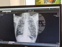 Кърджали - МБАЛ "Д-р Ат. Дафовски" - туберкулоза