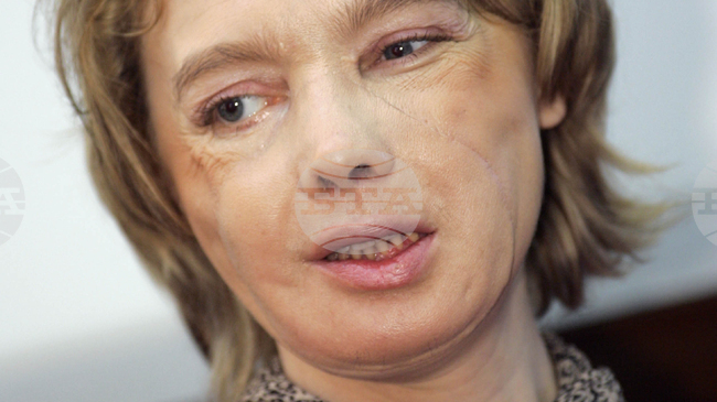 Трансплантация на части от лице е направена за първи път в света преди 20 години във Франция