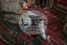 Mideast Wars Gaza Amputees