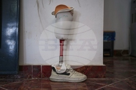 Mideast Wars Gaza Amputees