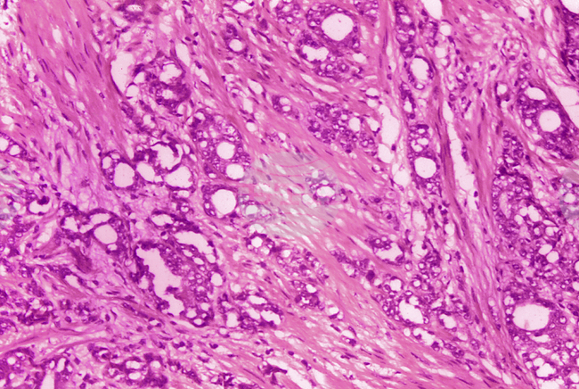 Учени създадоха роботи за борба с рака под формата на микромехурчета