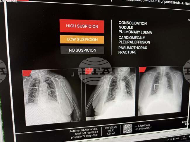 Система с изкуствен интелект е внедрена в Отделението по образна диагностика на великотърновската болница