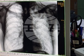Троян - белодробна болница - безплатни прегледи