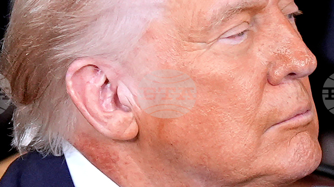 Тръмп е подложен на превантивно лечение заради обрив на врата, заяви негови лекар