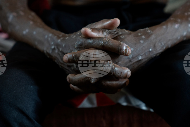 Congo-Mpox Outbreak