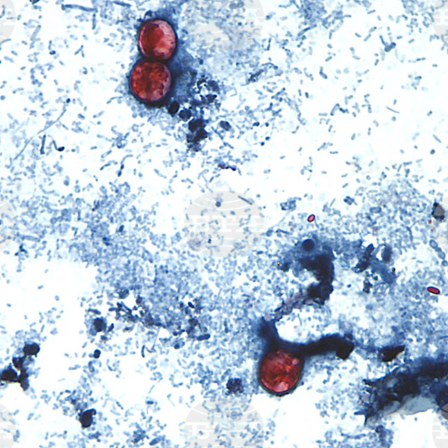 Cyclospora Outbreak