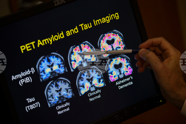 Be Well-Alzheimer's-Blood Tests