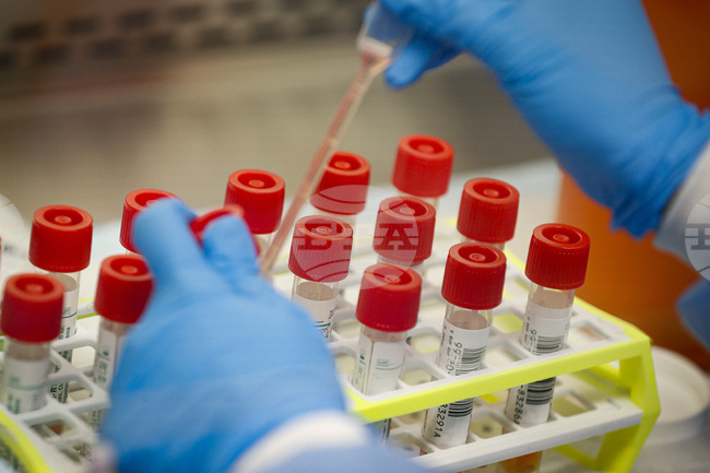 Австралийски изследователи започват изпитване на диагностичен тест за дълъг КОВИД-19