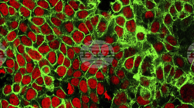 Учени установиха етап от развитието на рака на дебелото черво, който може да определи шансовете за успех на лечението