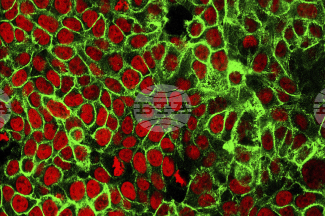 Учени установиха етап от развитието на рака на дебелото черво, който може да определи шансовете за успех на лечението