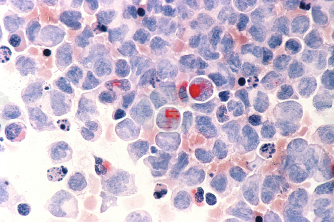 Учени установиха, че генетична мутация потиска развитието на рака