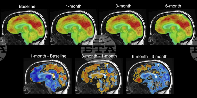 Учени разработиха имплант, който може да "расте" в мозъка
