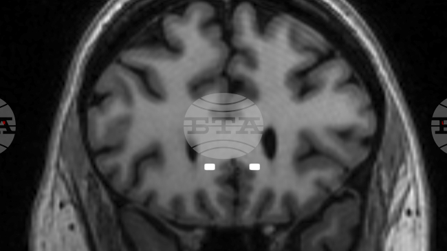 ТПС: „Невронният шум“ води до безпокойство, посттравматичен стрес и ирационално поведение, разкриха учените