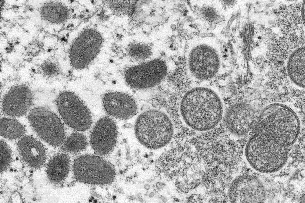 Досега в Хърватия десет души са диагностицирани с маймунска шарка