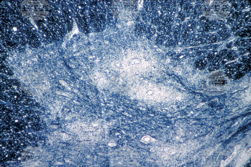 Дива форма на полиомиелит беше открита в проба от германска канализация, съобщи здравен институт