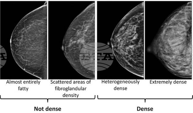 Учени разработиха метод на кръвни изследвания, базиран на изкуствен интелект, който позволява по-ранно откриване на рак на гърдата